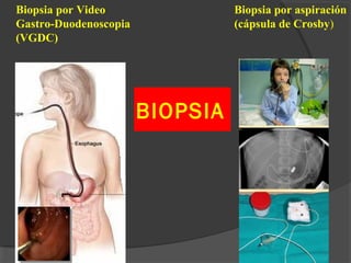 BIOPSIA
Biopsia por aspiración
(cápsula de Crosby)
Biopsia por Video
Gastro-Duodenoscopia
(VGDC)
 