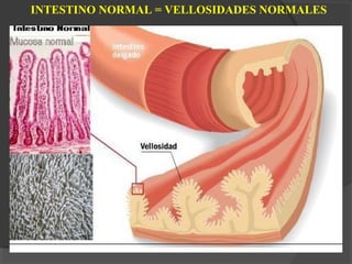 INTESTINO NORMAL = VELLOSIDADES NORMALES
 