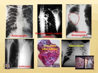 37
Broncografía
Bronquiectasia central
cilíndrica
Carcinoma
Broncogénico
Atelectasia
Atelectasia
lobar inferior
Tuberculosis
 