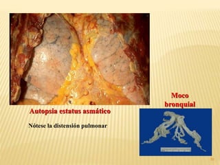 39
Autopsia estatus asmático
Moco
bronquial
Nótese la distensión pulmonar
 