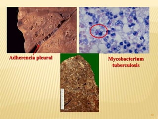 40
Adherencia pleural Mycobacterium
tuberculosis
 