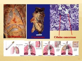 41
No fumador Carcinoma Células cancerosas
 