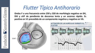 Flutter Típico Antihorario
Ondas F a una frecuencia entre 250 y 320 de morfología negativa en DII,
DIII y aVF de pendiente de descenso lenta y un ascenso rápido. Es
positiva en V1 precedida de un componente negativo y negativa en V6.
 