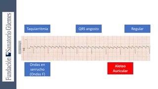 Taquiarritmia QRS angosto Regular
Ondas en
serrucho
(Ondas F)
Aleteo
Auricular
 