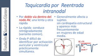 Taquicardia por Reentrada
intranodal
• Por doble vía dentro del
nodo AV, una lenta y otra
rápida
• La rápida conduce
retrógradamente
(variante común).
• Onda P difícil de
identificar por activación
auricular y ventricular
prácticamente
simultanea.
• Generalmente afecta a
sujetos
sin cardiopatía estructural
y aparece más
frecuentemente
en mujeres de edad
media.
 