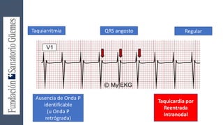 Taquiarritmia QRS angosto Regular
Ausencia de Onda P
identificable
(u Onda P
retrógrada)
Taquicardia por
Reentrada
Intranodal
 