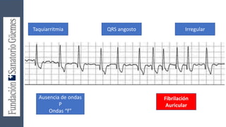 Taquiarritmia QRS angosto Irregular
Ausencia de ondas
P
Ondas “f”
Fibrilación
Auricular
 