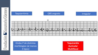 Taquiarritmia QRS angosto Irregular
Ondas P de distintas
morfologías (al menos
3 tipos)
Taquicardia
Auricular
Multifocal
 