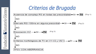Criterios de Brugada
 