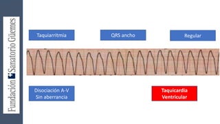 Taquiarritmia QRS ancho Regular
Disociación A-V
Sin aberrancia
Taquicardia
Ventricular
 