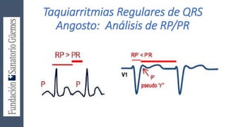 Taquiarritmias Regulares de QRS
Angosto: Análisis de RP/PR
 