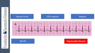 Taquiarritmia QRS angosto Regular
RP>PR Taquicardia Sinusal
 