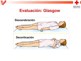 Evaluación: Glasgow
Decorticación
Descerebración
 