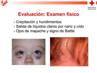 - Crepitación y hundimientos
- Salida de líquidos claros por nariz y oído
- Ojos de mapache y signo de Battle
Evaluación: Examen físico
 