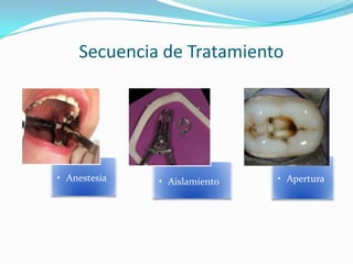 Secuencia de Tratamiento




• Anestesia   • Aislamiento   • Apertura
 