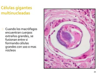 25
Cuando los macrófagos
encuentran cuerpos
extraños grandes, se
fusionan entre si
formando células
grandes con 100 o mas
núcleos
 