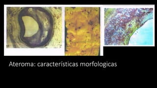 Ateroma: características morfologicas
 