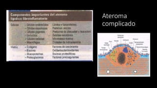Ateroma
complicado
 