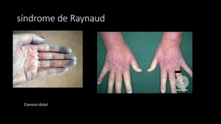 síndrome de Raynaud
Cianosis distal
 