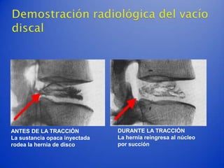 ANTES DE LA TRACCIÓN           DURANTE LA TRACCIÓN
La sustancia opaca inyectada   La hernia reingresa al núcleo
rodea la hernia de disco       por succión
 