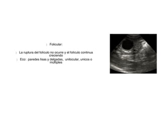 } Folicular:
} La ruptura del folículo no ocurre y el folículo continua
creciendo
} Eco: paredes lisas y delgadas, unilocular, unicos o
múltiples
 