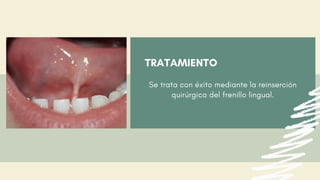 TRATAMIENTO
Se trata con éxito mediante la reinserción
quirúrgica del frenillo lingual.
 