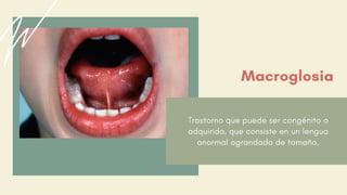 Trastorno que puede ser congénito o
adquirida, que consiste en un lengua
anormal agrandada de tamaño.
Macroglosia
 