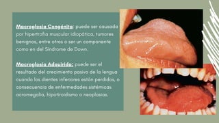 Macroglosia Congénita: puede ser causada
por hipertrofia muscular idiopática, tumores
benignos, entre otros o ser un componente
como en del Síndrome de Down.
Macroglosia Adquirida: puede ser el
resultado del crecimiento pasivo de la lengua
cuando los dientes inferiores están perdidos, o
consecuencia de enfermedades sistémicas
acromegalia, hipotiroidismo o neoplasias.
 