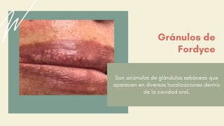 Son acúmulos de glándulas sebáceas que
aparecen en diversas localizaciones dentro
de la cavidad oral.
Gránulos de
Fordyce
 