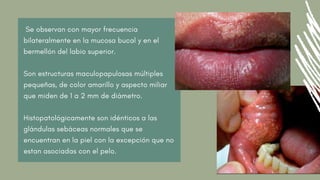 Se observan con mayor frecuencia
bilateralmente en la mucosa bucal y en el
bermellón del labio superior.
Son estructuras maculopapulosas múltiples
pequeñas, de color amarillo y aspecto miliar
que miden de 1 a 2 mm de diámetro.
Histopatológicamente son idénticos a las
glándulas sebáceas normales que se
encuentran en la piel con la excepción que no
estan asociadas con el pelo.
 