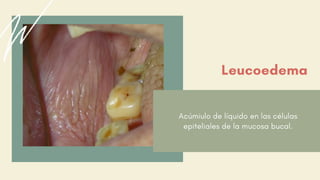 Acúmiulo de líquido en las células
epiteliales de la mucosa bucal.
Leucoedema
 
