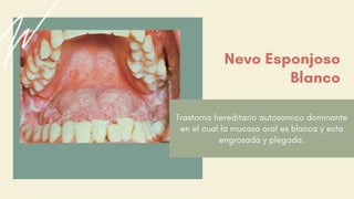 Trastorno hereditario autosómico dominante
en el cual la mucosa oral es blanca y esta
engrosada y plegada.
Nevo Esponjoso
Blanco
 