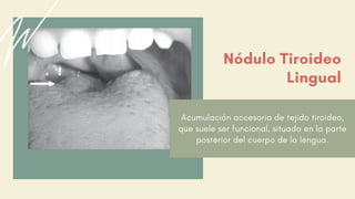 Acumulación accesoria de tejido tiroideo,
que suele ser funcional, situada en la parte
posterior del cuerpo de la lengua.
Nódulo Tiroideo
Lingual
 