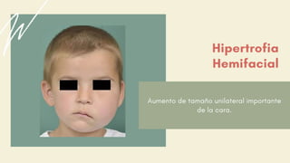 Aumento de tamaño unilateral importante
de la cara.
Hipertrofia
Hemifacial
 