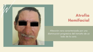 Afección rara caracterizada por una
disminución progresiva del tamaño de un
lado de la cara.
Atrofia
Hemifacial
 