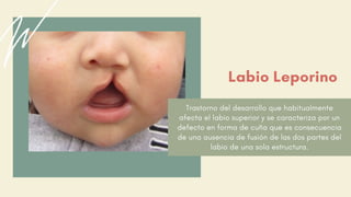 Trastorno del desarrollo que habitualmente
afecta el labio superior y se caracteriza por un
defecto en forma de cuña que es consecuencia
de una ausencia de fusión de las dos partes del
labio de una sola estructura.
Labio Leporino
 