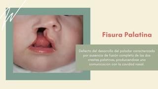 Defecto del desarrollo del paladar caracterizado
por ausencia de fusión completa de las dos
crestas palatinas, produciendose una
comunicación con la cavidad nasal.
Fisura Palatina
 