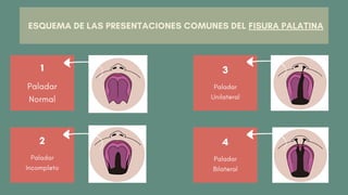 2
Paladar
Incompleto
3
Paladar
Unilateral
4
Paladar
Bilateral
1
Paladar
Normal
ESQUEMA DE LAS PRESENTACIONES COMUNES DEL FISURA PALATINA
 