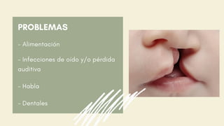 PROBLEMAS
- Alimentación
- Infecciones de oído y/o pérdida
auditiva
- Habla
- Dentales
 