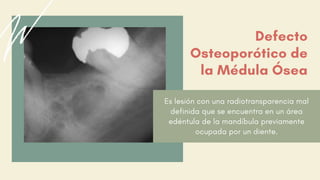 Es lesión con una radiotransparencia mal
definida que se encuentra en un área
edéntula de la mandíbula previamente
ocupada por un diente.
Defecto
Osteoporótico de
la Médula Ósea
 