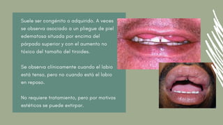 Suele ser congénito o adquirido. A veces
se observa asociado a un pliegue de piel
edematosa situada por encima del
párpado superior y con el aumento no
tóxico del tamaño del tiroides.
Se observa clínicamente cuando el labio
está tenso, pero no cuando está el labio
en reposo.
No requiere tratamiento, pero por motivos
estéticos se puede extirpar.
 