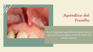 Es un fragmento superfluo de tejido mucoso
que se proyecta desde el frenillo labial del
maxilar superior.
Apéndice del
Frenillo
 