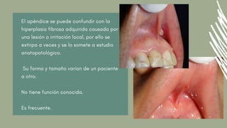 El apéndice se puede confundir con la
hiperplasia fibrosa adquirida causada por
una lesión o irritación local, por ello se
extirpa a veces y se lo somete a estudio
anatopatológico.
Su forma y tamaño varían de un paciente
a otro.
No tiene función conocida.
Es frecuente.
 