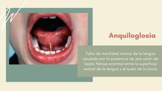 Falta de movilidad normal de la lengua
causada por la presencia de una unión de
tejido fibroso anormal entre la superficie
ventral de la lengua y el suelo de la boca.
Anquiloglosia
 