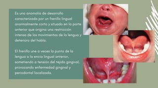 Es una anomalía de desarrollo
caracterizada por un frenillo lingual
anormalmente corto y situado en la parte
anterior que origina una restricción
intensa de los movimientos de la lengua y
deterioro del habla.
El frenillo une a veces la punta de la
lengua a la encia lingual anterior,
sometiendo a tensión del tejido gingival,
provocando enfermedad gingival y
periodontal localizada.
 