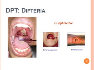 DPT: DIFTERIA
27
 