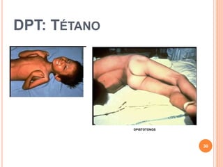 DPT: TÉTANO
30
 