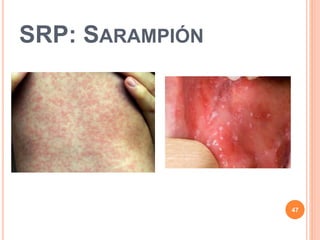 SRP: SARAMPIÓN
47
 