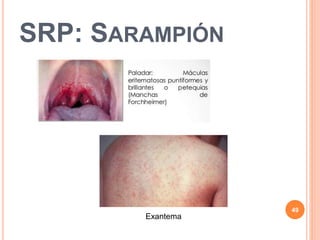 SRP: SARAMPIÓN
49
Exantema
 