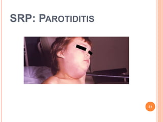 SRP: PAROTIDITIS
51
 
